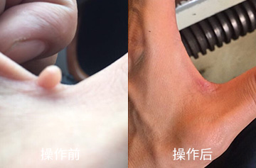 肉瘤