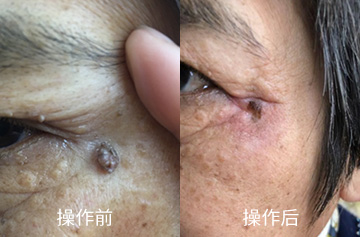 血管瘤