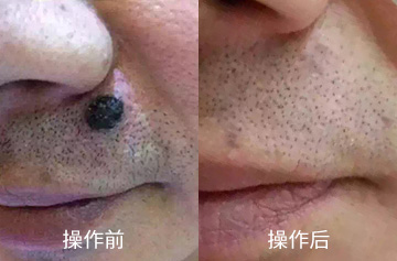 肉瘤