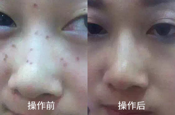 黑痣